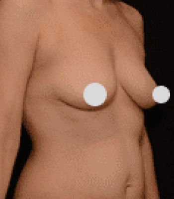 Nude female torso with privacy covers.